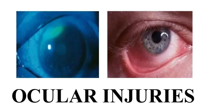 Ocular Trauma Services