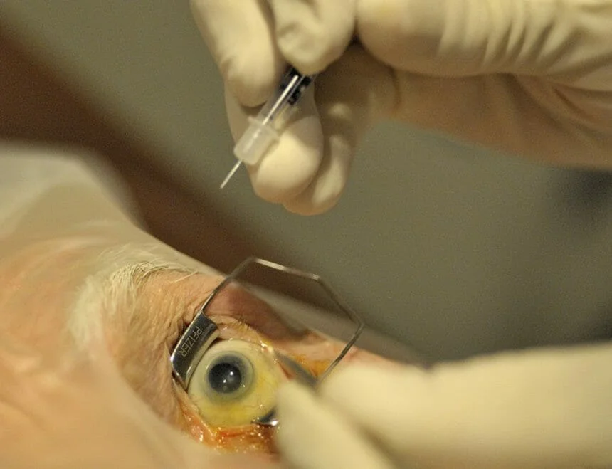 Intravitreal Injections
