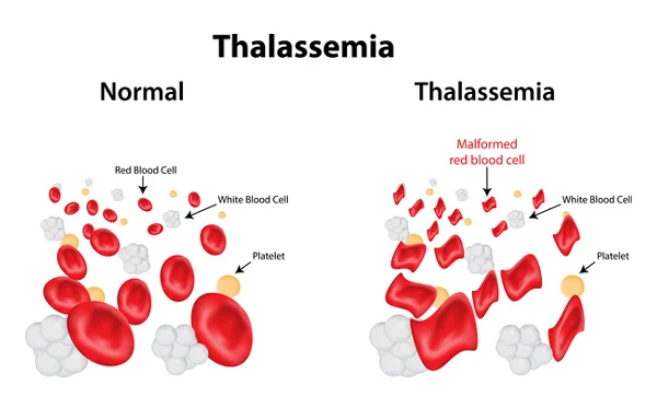 Thalassemia